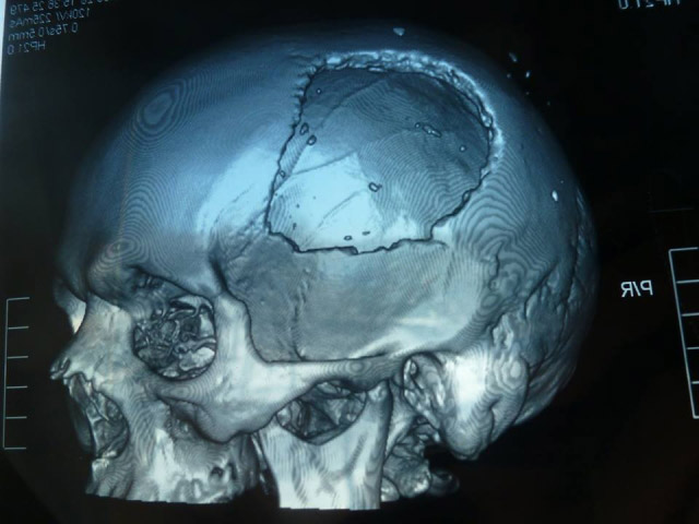 Radiografia del cranio della vittima morsa da un orso