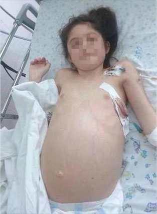 New Day: Un parassita esotico in un anno ha divorato intestini di una bambina di 11 anni