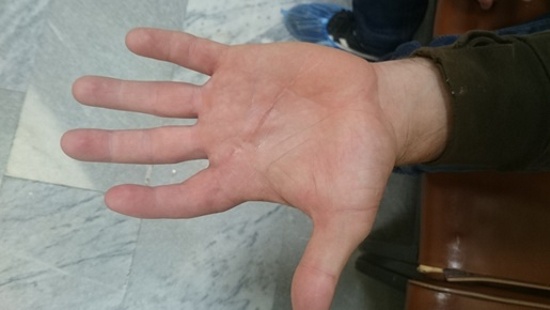 New Day: Ricucitura riuscita di una mano tagliata con la motosega a un siberiano (FOTO)