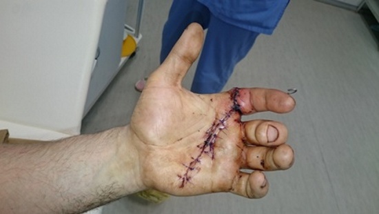 New Day: Ricucitura riuscita di una mano tagliata con la motosega a un siberiano (FOTO)
