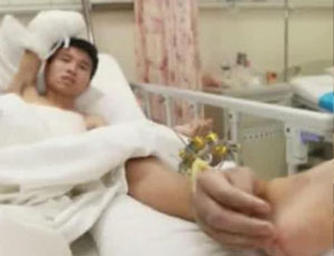 Chirurghi cinesi salvano una mano amputata cucendola per un mese alla caviglia del paziente